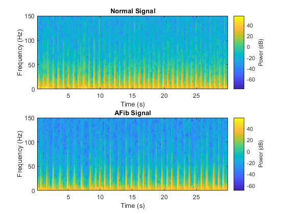 Classify Ecg Signals Using Lstm Networks Artificial Intelligence Matlab And Simulink