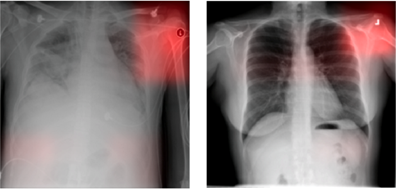 Explainable AI techniques reveal that pneumonia classifier is classifying medical marker.